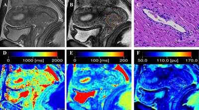 Predicting the status of lymphovascular space invasion using quantitative parameters from synthetic MRI in cervical squamous cell carcinoma without lymphatic metastasis